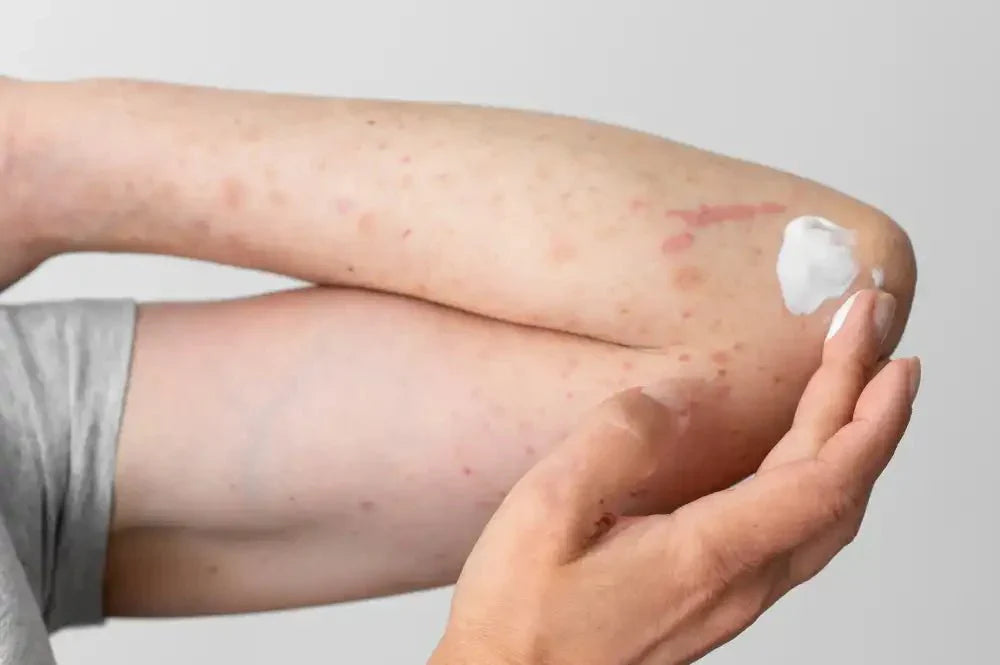 16 Natural Remedies for Eczema Rash Relief – Sweet Bee Naturals