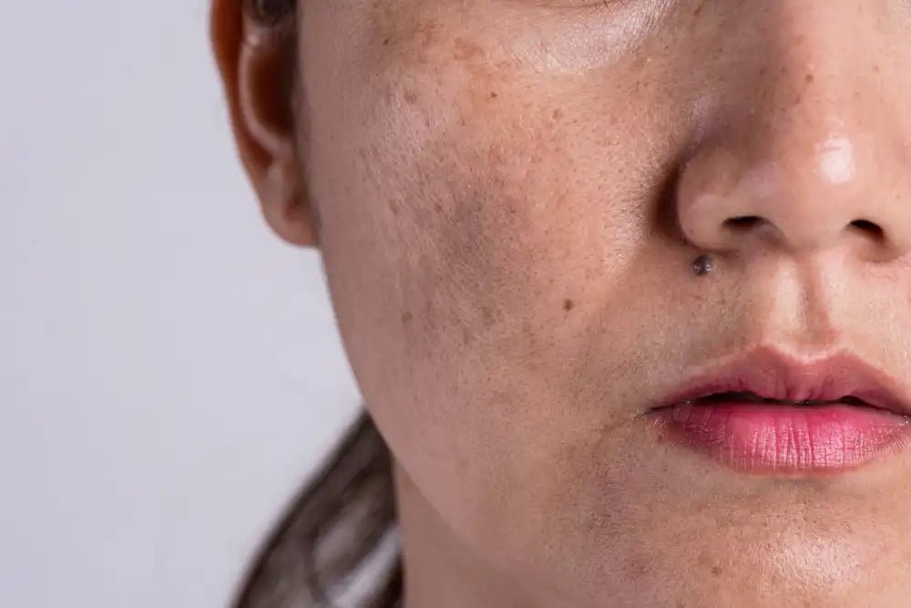 Dark Spots: Causes and Ways to Get Rid of Them - Sweet Bee Naturals