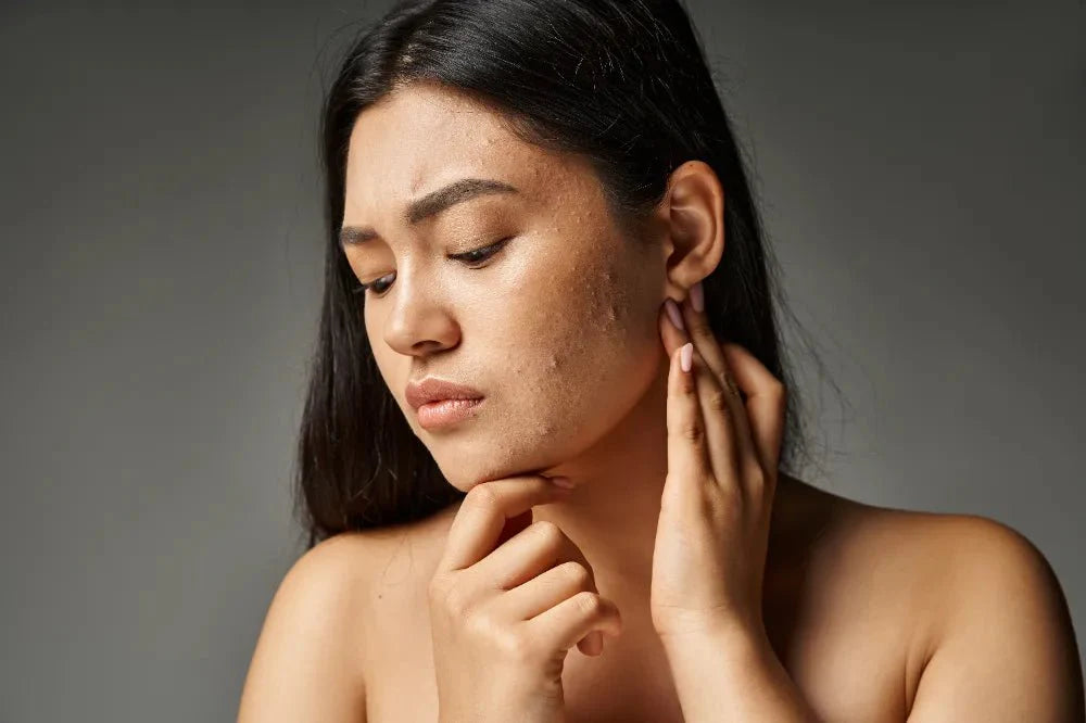 Deep Ruddy Skin How to Calm Ruddy Skin Naturally Without Irritation – Sweet Bee Naturals