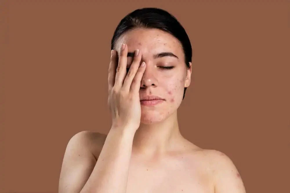 The Best Face Wash Remedies for Oily Skin: Top Picks for a Clean and Balanced Complexion - Sweet Bee Naturals