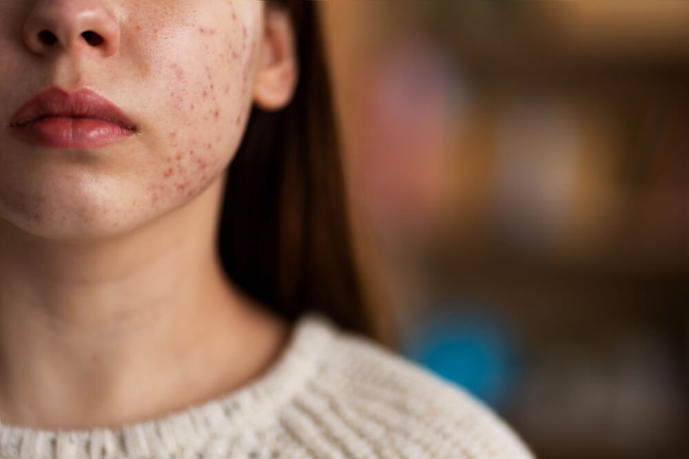 What’s the Difference Between Skin Purging and a Breakout? - Sweet Bee Naturals
